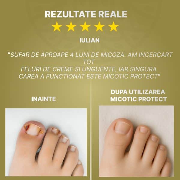 parere-iulian-despre-micotic-protect